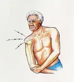 dislocated shoulder.webp
