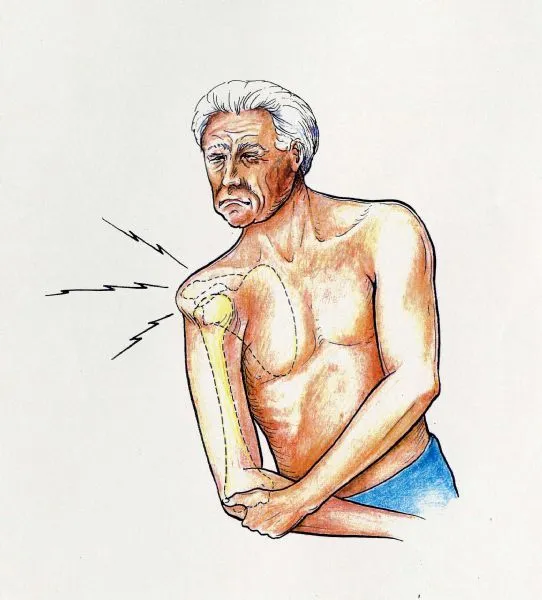 dislocated shoulder.jpg